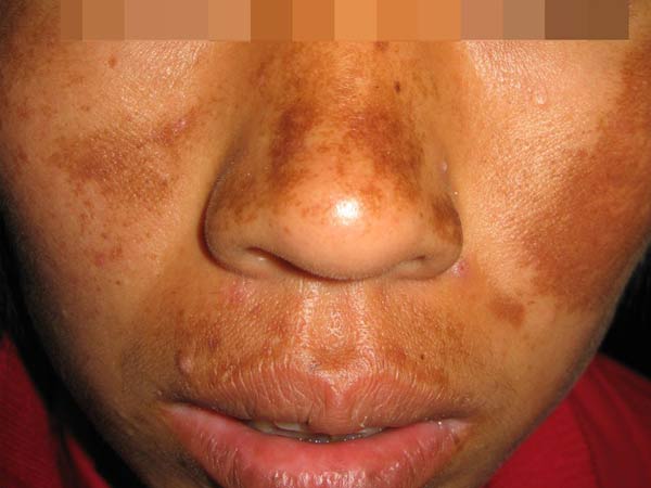 黄褐斑根治的方法有什么