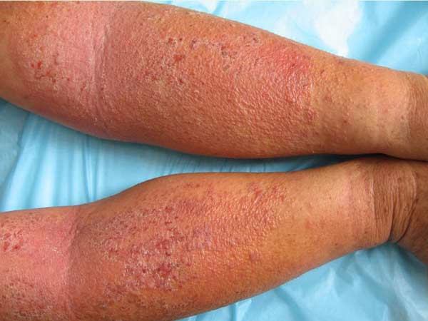 湿疹如何去治疗 - 皮肤病 - 39健康网